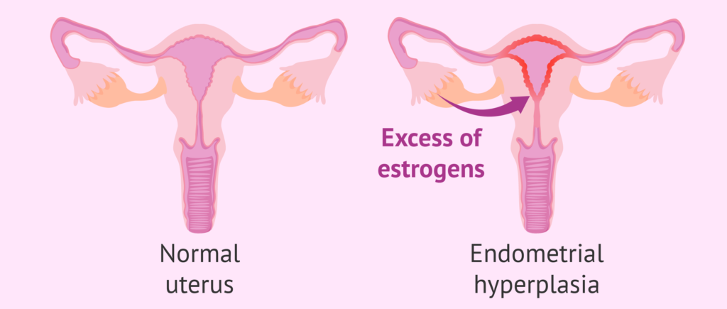 Endometrial-hyperplasia