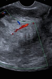 endometrial-cancer endometrial-cancer