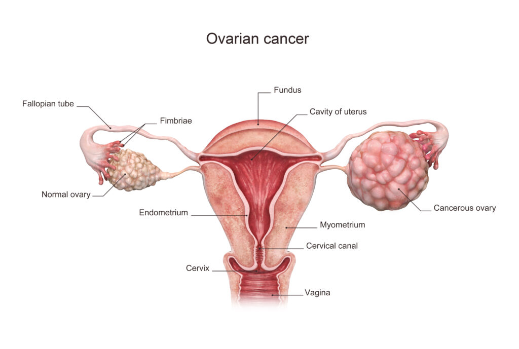 3d rendered ovarian cancer illustration.