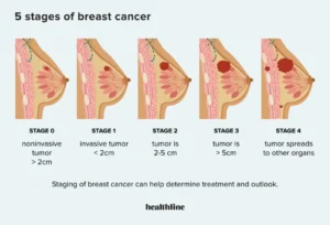 stages-of-cancer