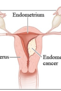urine-cancer-1 urine-cancer-1