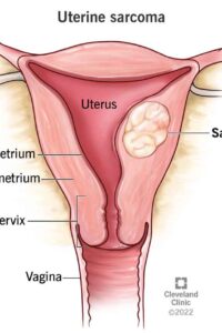 uterine-cancer-2 uterine-cancer-2