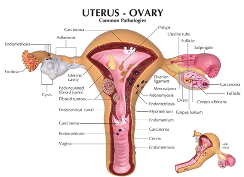 uterus-ovary